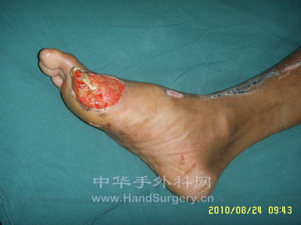 1.前足缺损创面