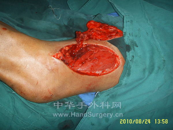 3.术中皮瓣的切取