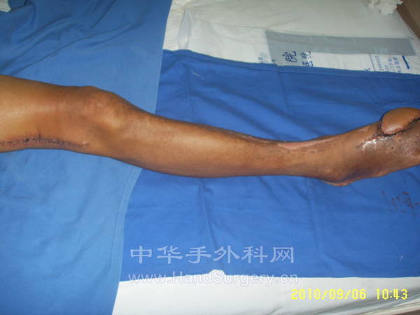 5.术后13天供受区