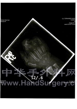 Hand-R-08-X Ray.JPG