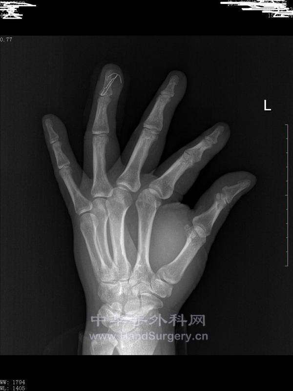 术后1.jpg