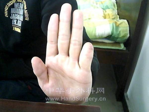 断指3.jpg