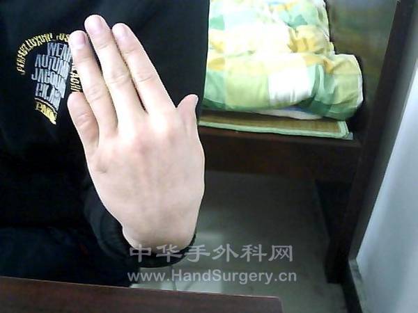 断指1.jpg