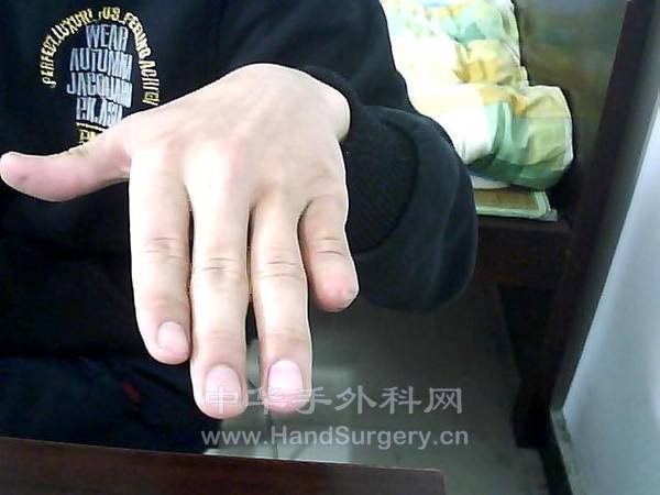 断指2.jpg