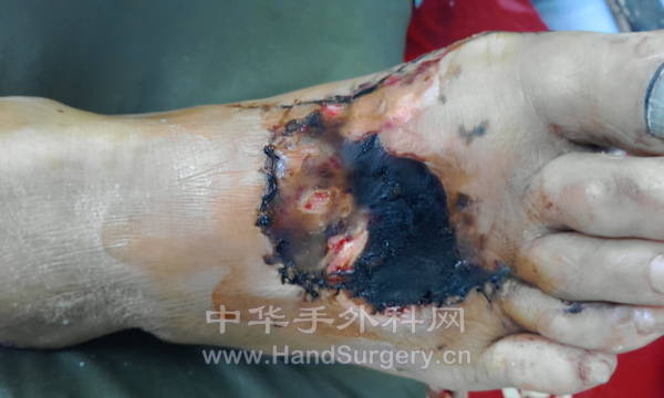 足背皮肤坏死