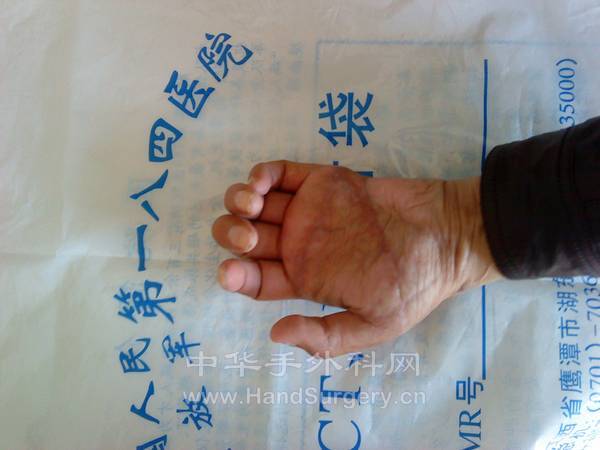 术后