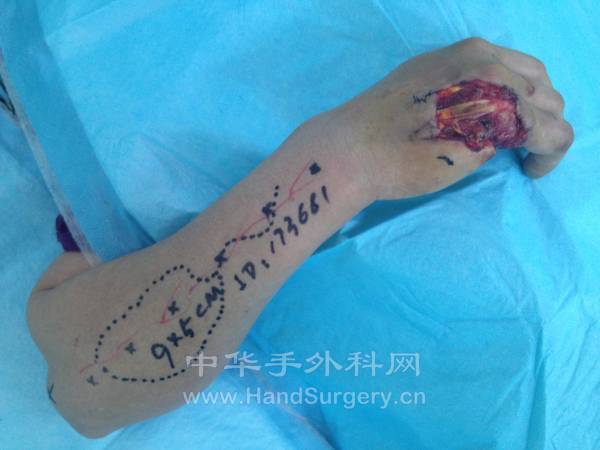 骨间背皮瓣设计