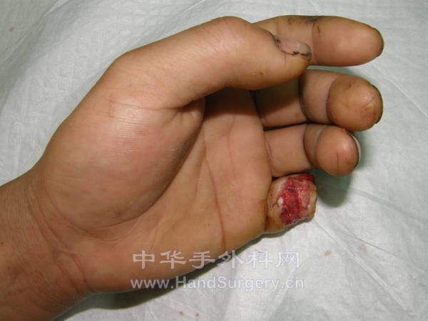 左小指损伤情况