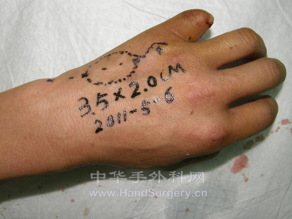 第四掌背皮瓣设计