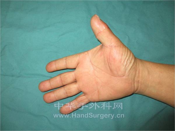 术后3个月随访