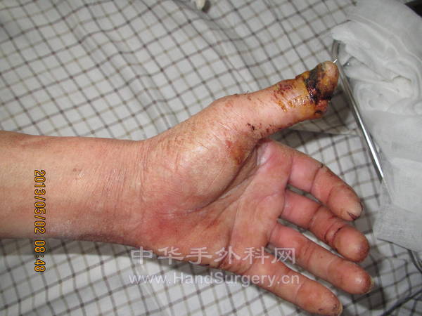术后两周，全部存活
