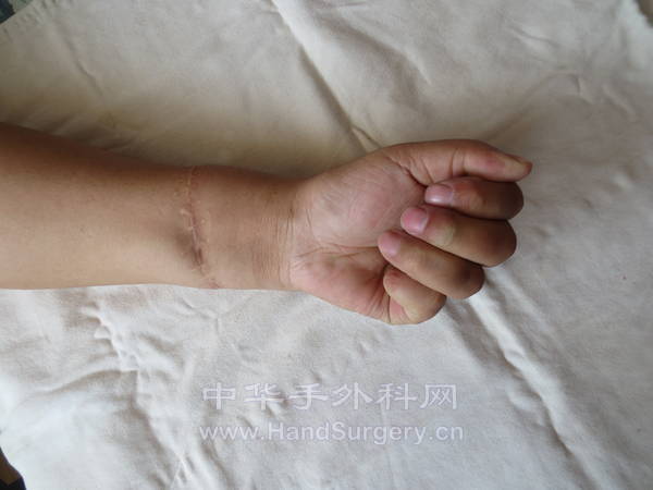 握拳  掌侧观