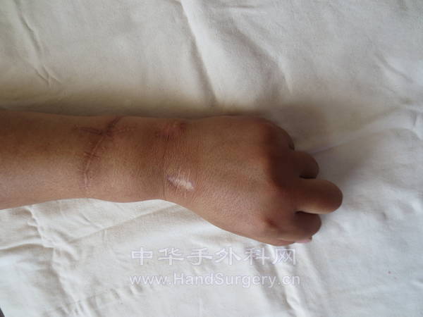 握拳 背侧观