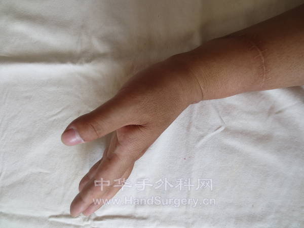 腕关节背伸功能