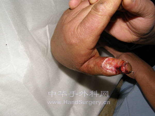 左手拇指掌侧损伤情况