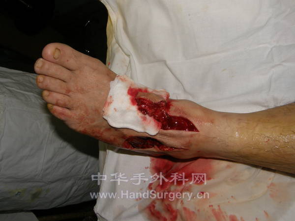 皮瓣切取保留趾短伸肌的完整性