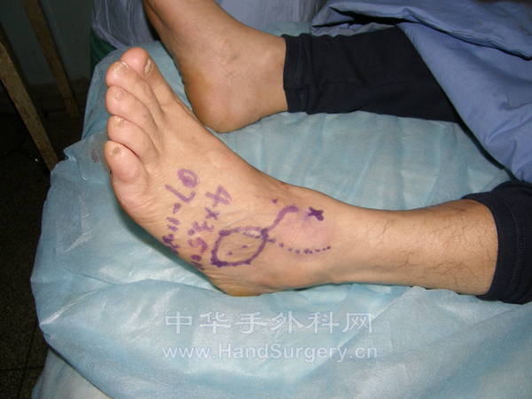 左足跗外侧动脉皮瓣设计