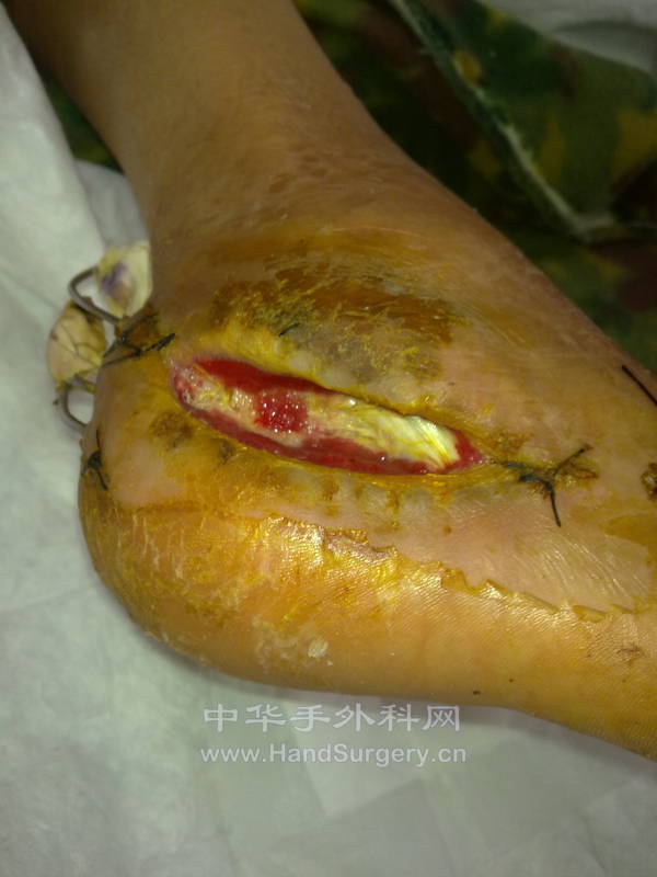 创面