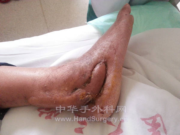 皮瓣成活