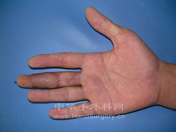 术后30天
