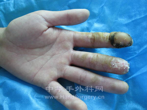 术后1.5月