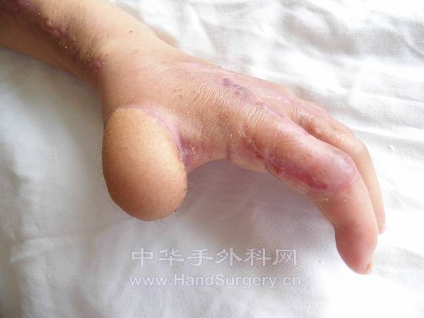 术后一月复查