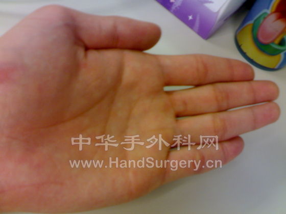 手平伸时的情况2