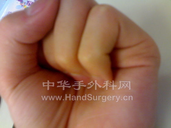 握拳近照，无名指和小指无法握紧，还留有空隙