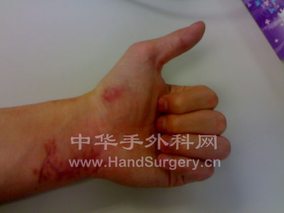 握拳程度，无名指和小指还差3-5毫米左右接触到掌心
