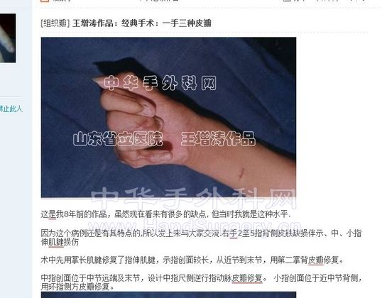 手背皮瓣.jpg
