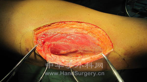 内侧切开皮瓣见近端穿支血管自股直肌穿出