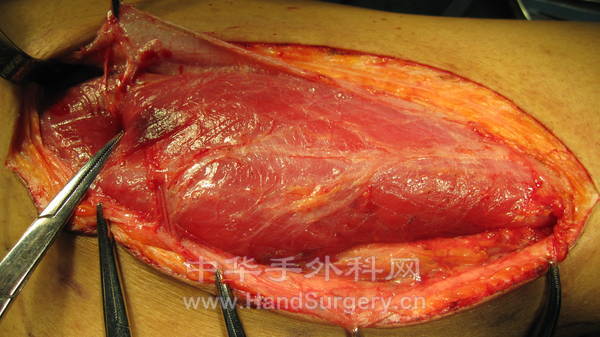 分离肌肉穿支见血管穿行表浅