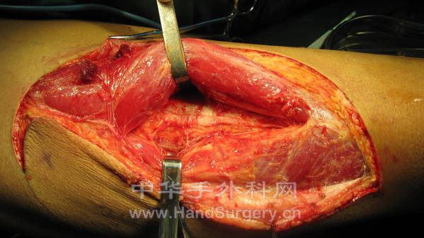 打开股直肌与股外侧肌间隙查看旋股外侧动脉降支发出的远端穿支血管