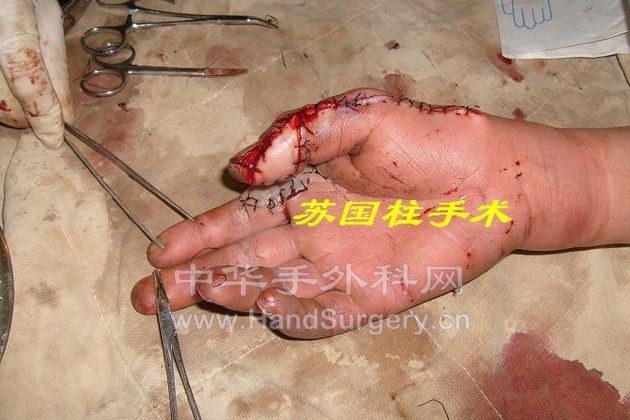 术后.JPG