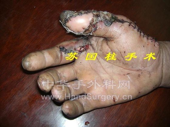 右拇指皮肤缺损术后.JPG