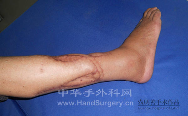 8 半年后复诊供区情况.jpg
