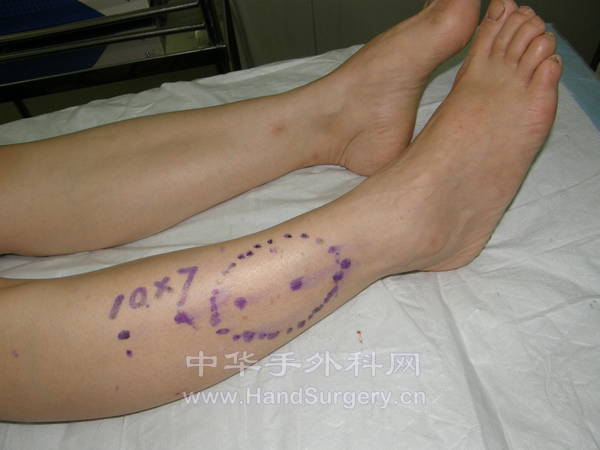 腓浅动脉皮瓣设计