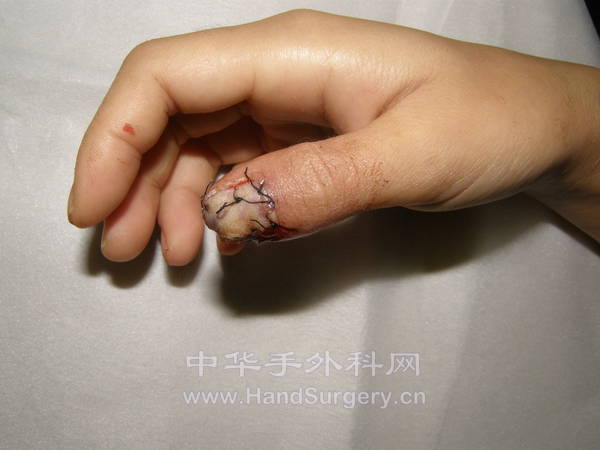 右手拇指甲床缺损行植皮