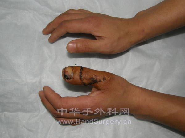 再造指与正常指对照