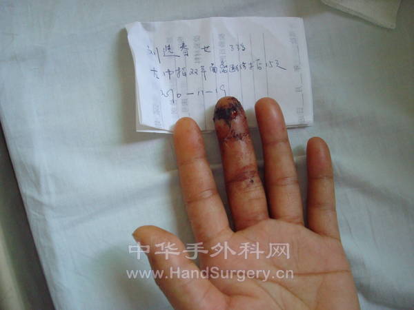 刘选春术后3.JPG