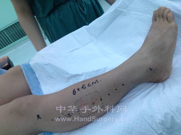 腓动脉穿支皮瓣的设计