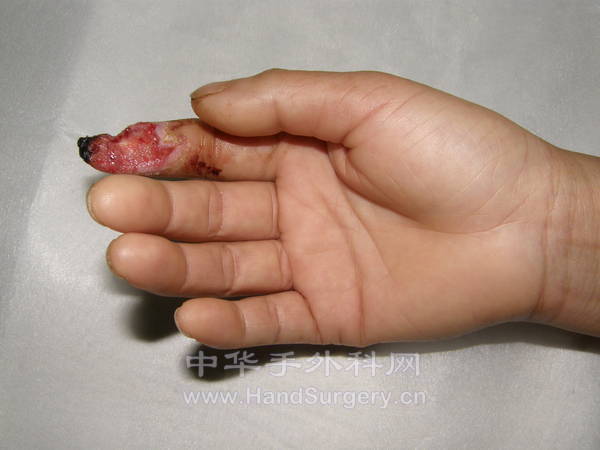 右手食指末节指腹缺损