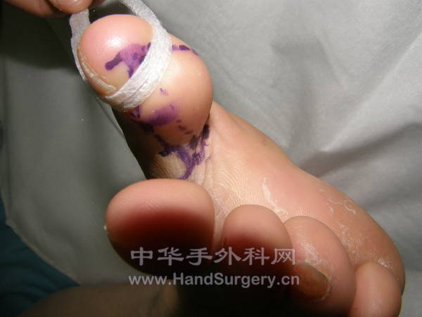 左足拇趾腓侧皮瓣设计