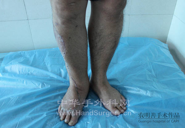 术后6周