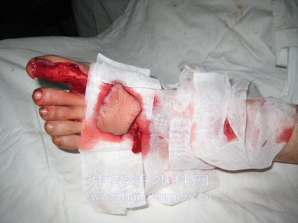 跗外侧皮瓣切取