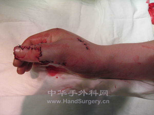 拇甲瓣修复术后