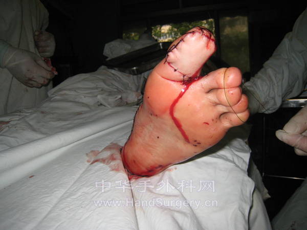 游离跗外侧皮瓣修复术后