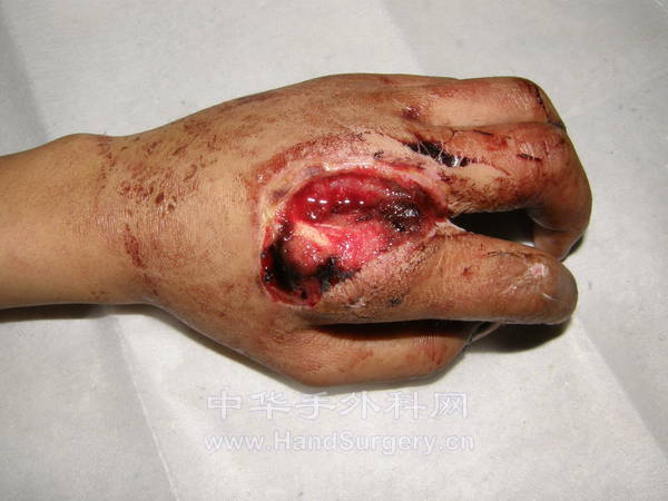 左手食指掌背组织缺损