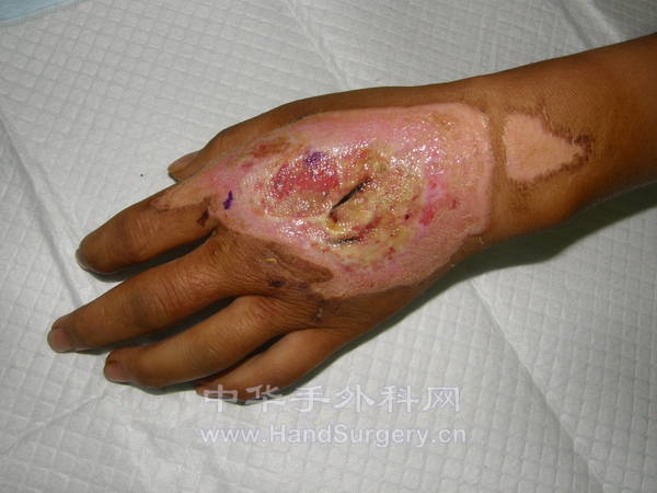 左手背组织缺损