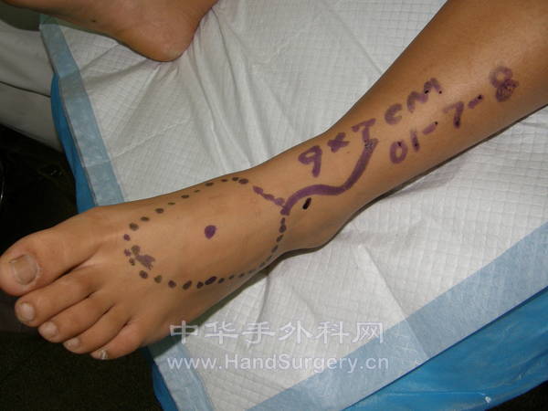 左足背皮瓣设计